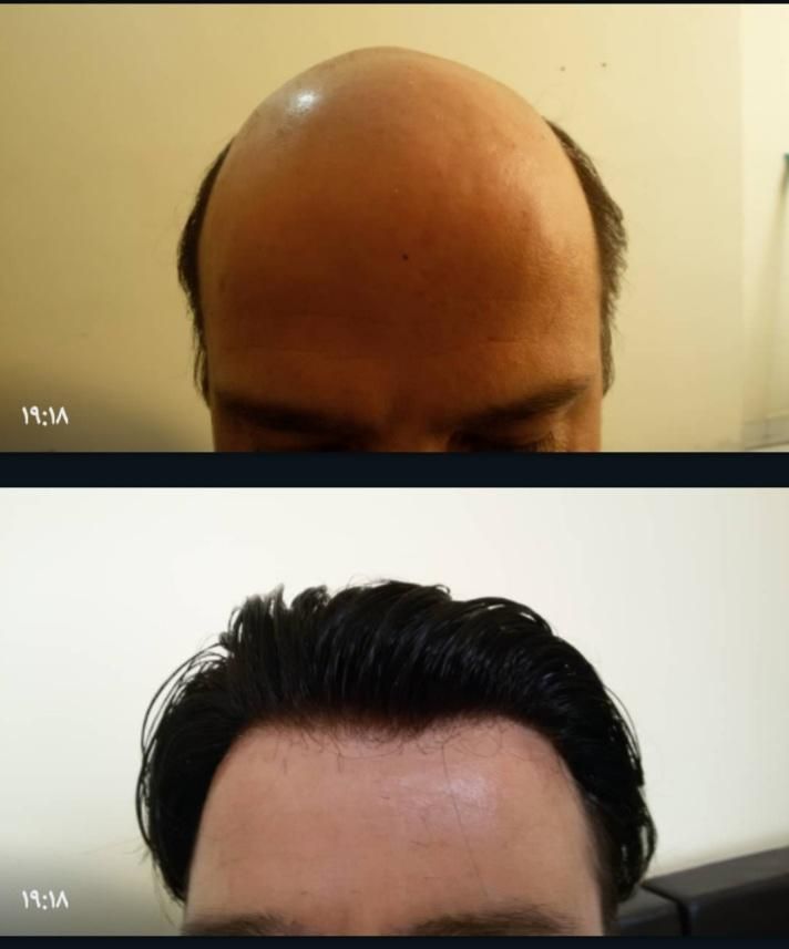 پروتز مو و ترمیم موی شقایق. چسب پروتز|خدمات آرایشگری و زیبایی|تبریز, |دیوار