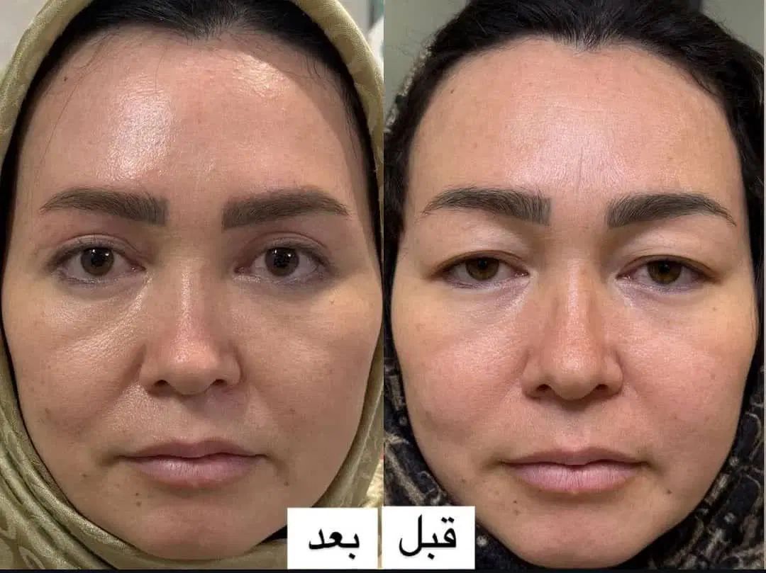 بوتاکس فیلر بلفاروپلاسی تزریق چربی نخ لیفت فشیال|خدمات آرایشگری و زیبایی|اصفهان, ملک‌شهر|دیوار