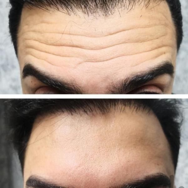 بوتاکس،تزریق ژل،مزوزیرچشم وصورت ،پرسینگ محمدشهر|خدمات آرایشگری و زیبایی|محمدشهر, محمدشهر|دیوار