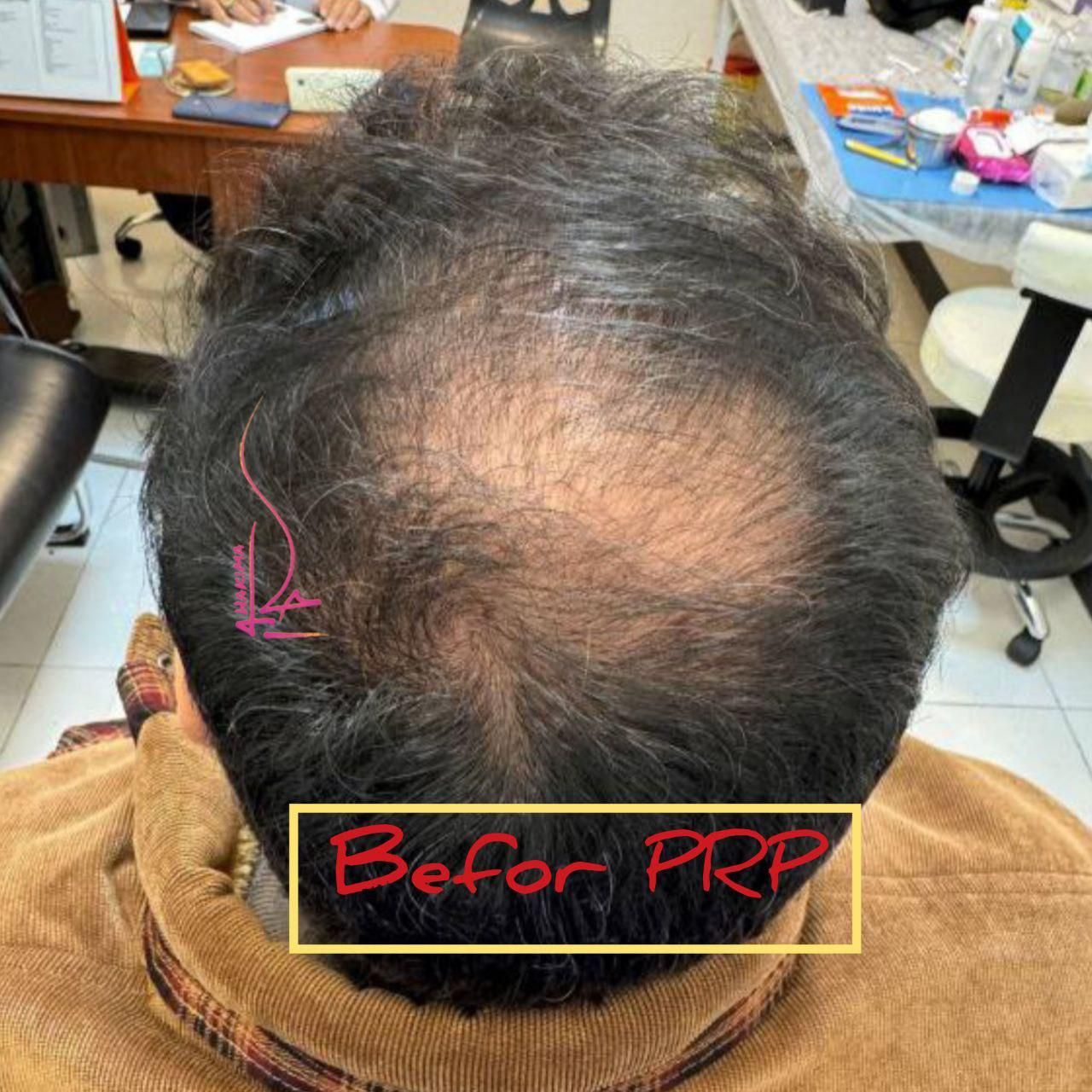 پی ار پی مو،صورت،اگزوزوم،مزوتراپی،هیرفیلر PRP|خدمات آرایشگری و زیبایی|تهران, هفت حوض|دیوار