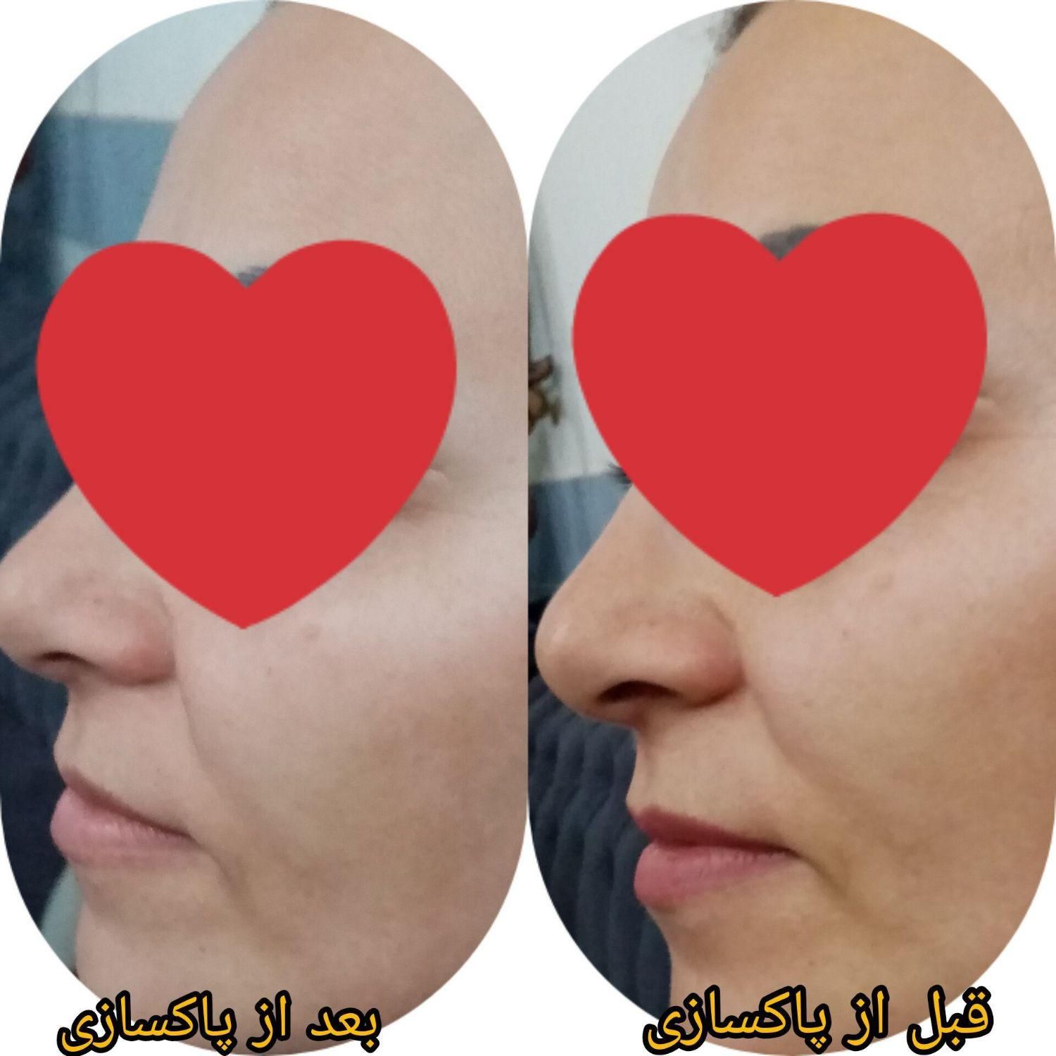 فیشیال و پاکسازی تخصصی پوست|خدمات آرایشگری و زیبایی|قم, قلعه کامکار|دیوار