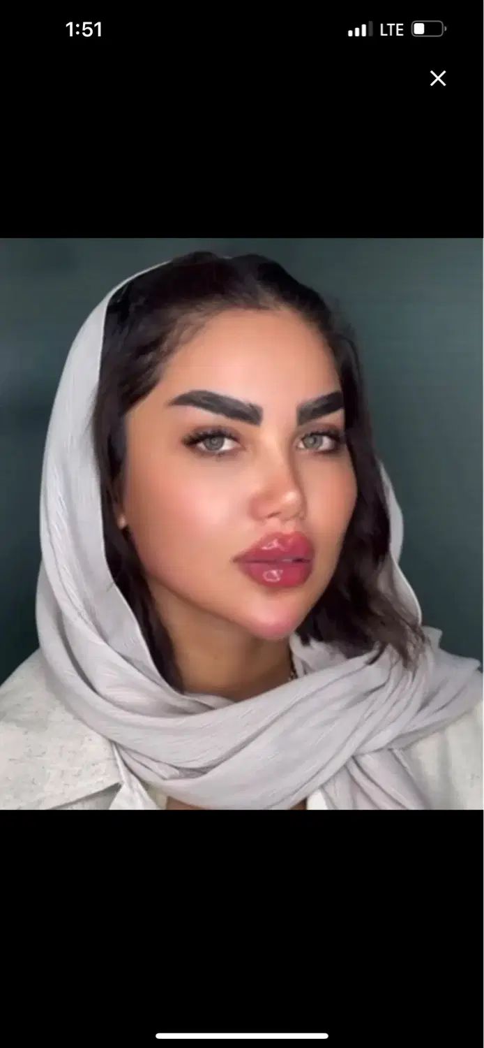 تزریق ژل و بوتاکس پکیج ۵۹۰۰ ماندگاری ۱ سال تضمینی|خدمات آرایشگری و زیبایی|تهران, تهرانپارس غربی|دیوار