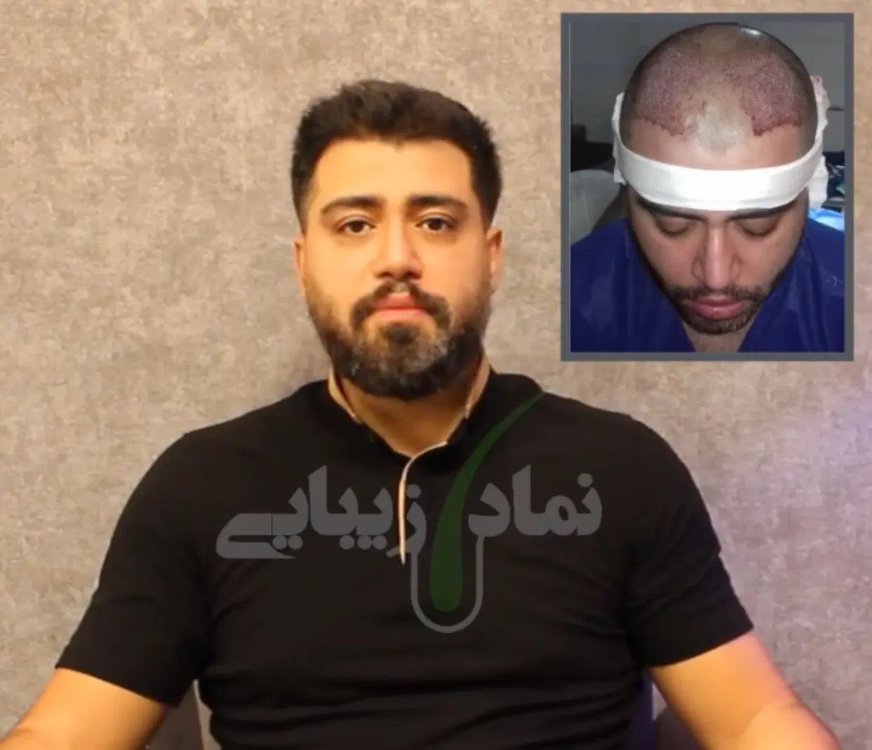 کاشت مو با تراکم بالا فقط با ۸ میلیون پیش‌پرداخت|خدمات آرایشگری و زیبایی|تهران, جردن|دیوار
