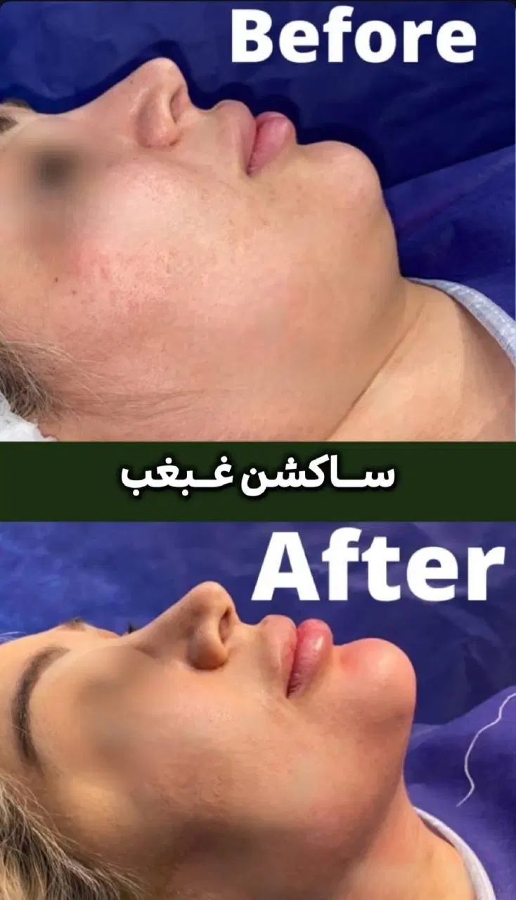 ساکشن غبغب و خدمات زیبایی با شرایط تمام اقساط|خدمات آرایشگری و زیبایی|تهران, شهرک غرب|دیوار