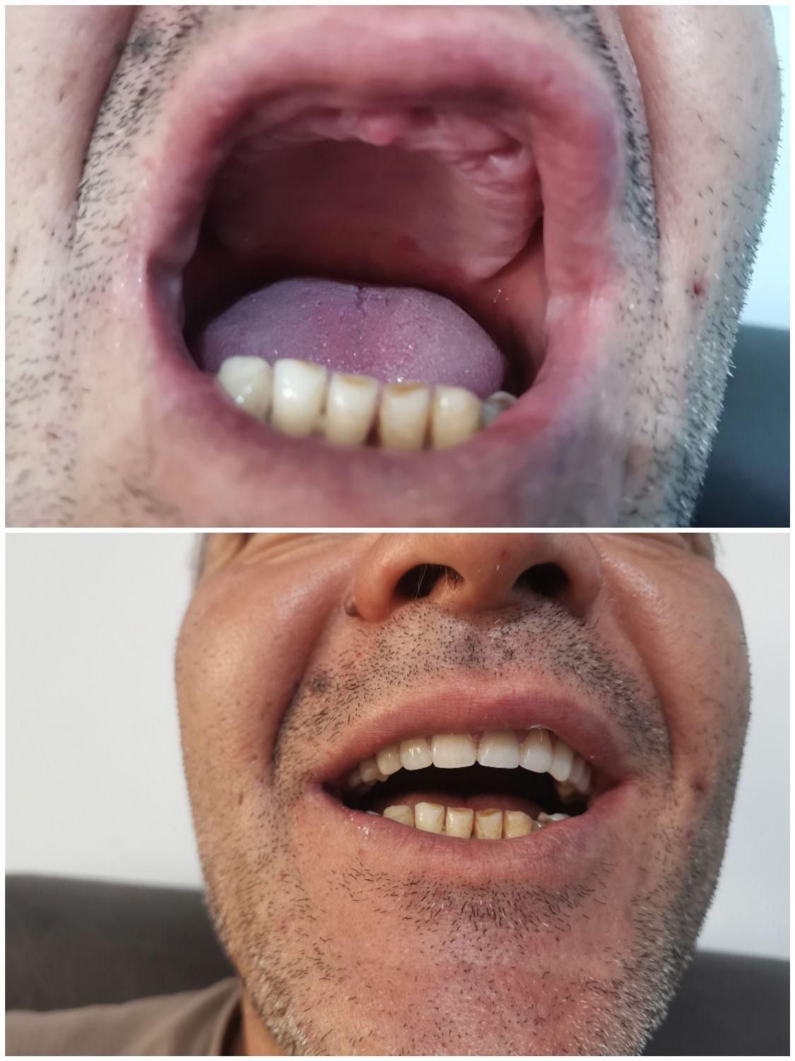 تعمییر وساخت دندان مصنوعی 10 میلیون|خدمات آرایشگری و زیبایی|تنکابن, |دیوار