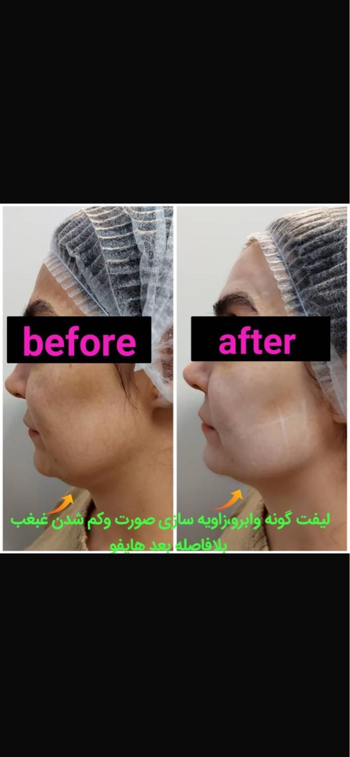 جشنواره  تابستانه ی هایفو ۷ بعدی فقط به مدت ۱۰ روز|خدمات آرایشگری و زیبایی|تهران, آسمان|دیوار