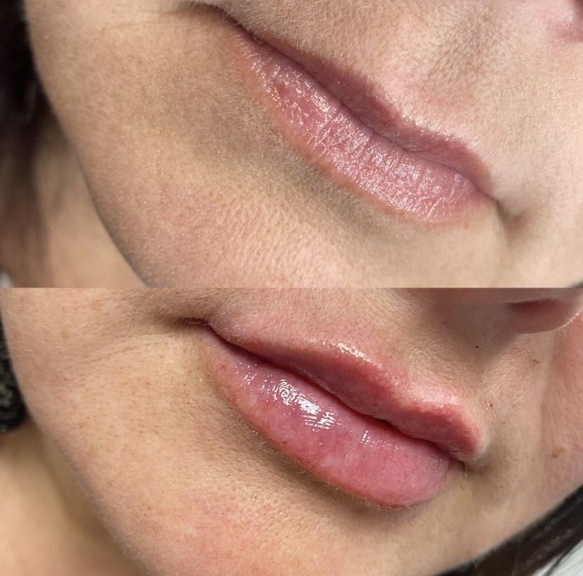 خدمات زیبایی صورت مزوتراپی بوتاکس فیلر|خدمات آرایشگری و زیبایی|شهریار, شهریار|دیوار