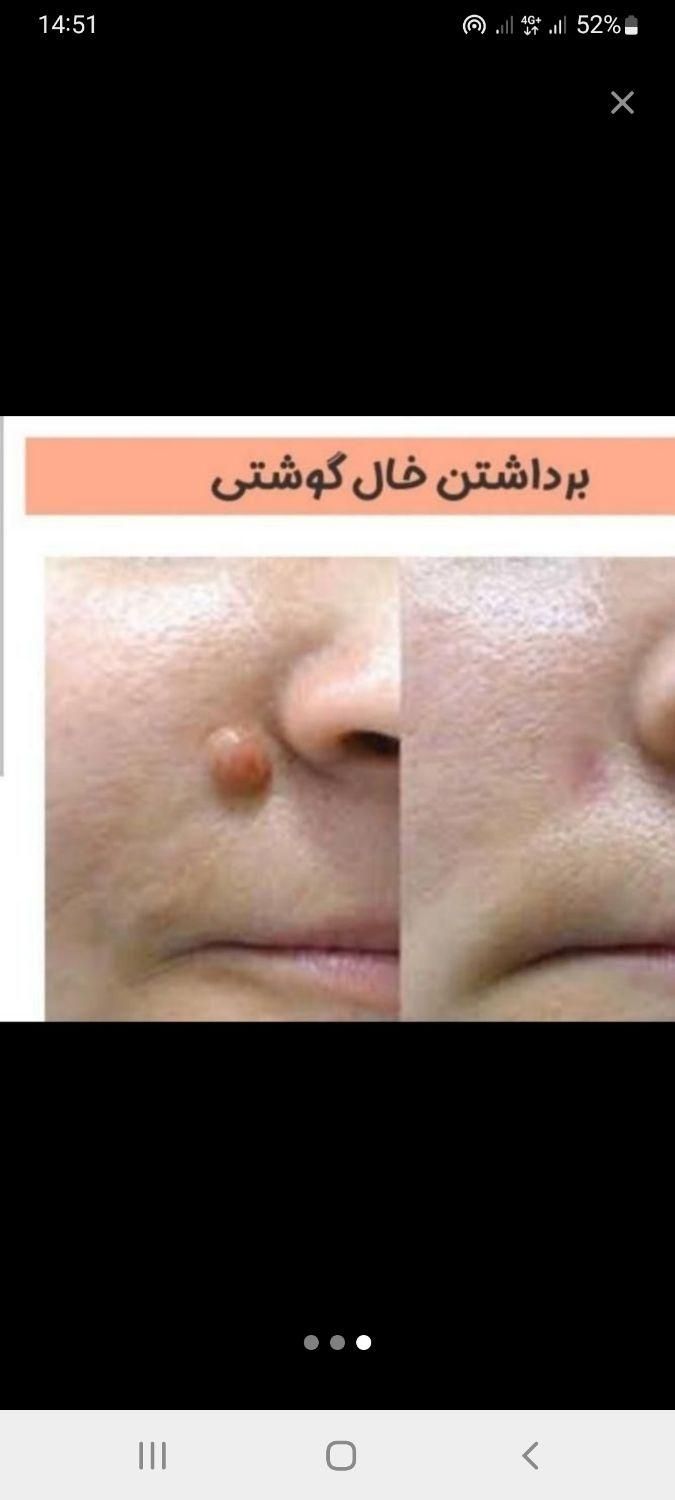 برداشتن خال های گوشتی و انجام تتو بدن و فیبروز|خدمات آرایشگری و زیبایی|ارومیه, |دیوار