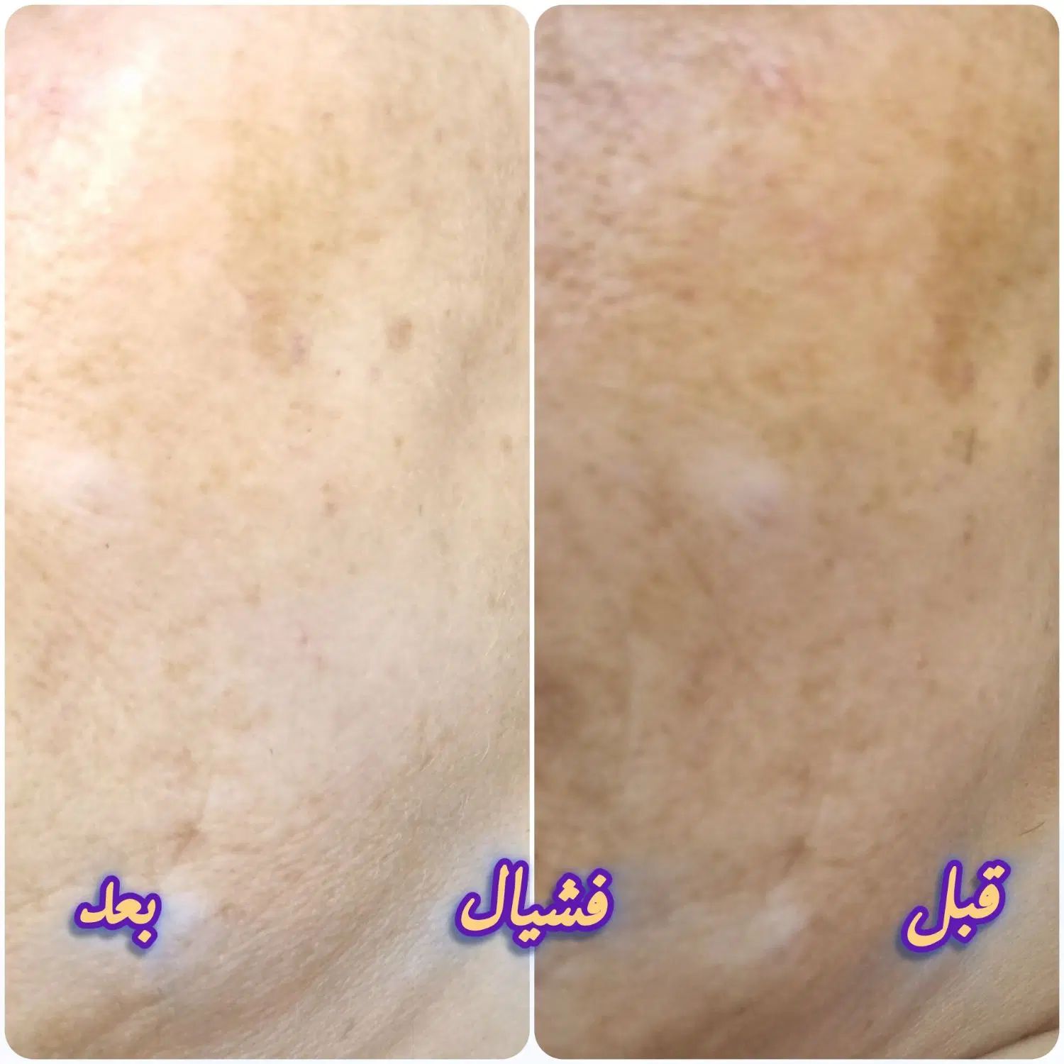 پاکسازی و جوانسازی پوست....و کاشت وترمیم ناخن|خدمات آرایشگری و زیبایی|شهریار, شهریار|دیوار