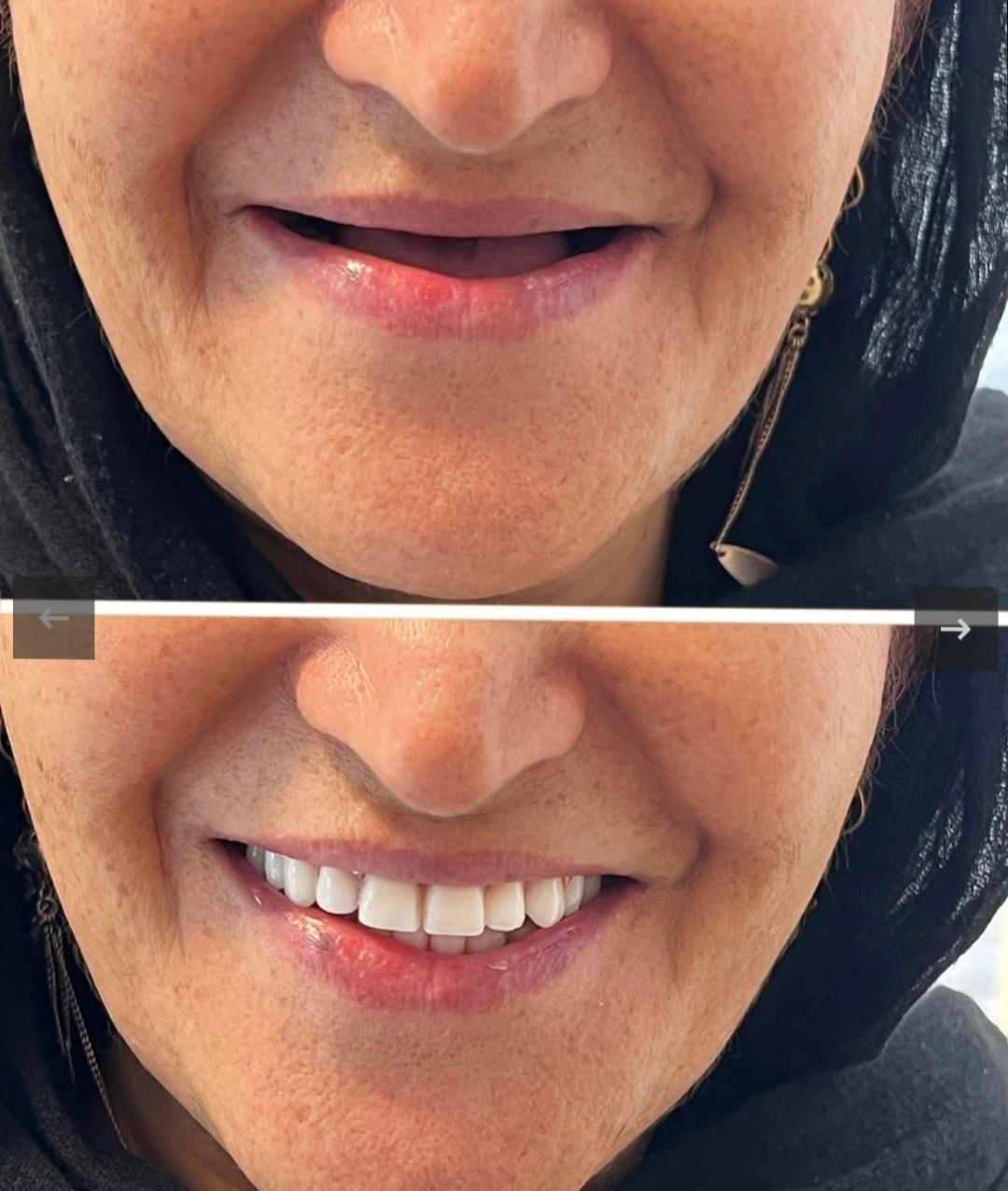 دندان مصنوعی بدون سقف*فلکسیبل*جایگزین ایمپلنت|خدمات آرایشگری و زیبایی|ری, دولتآباد|دیوار