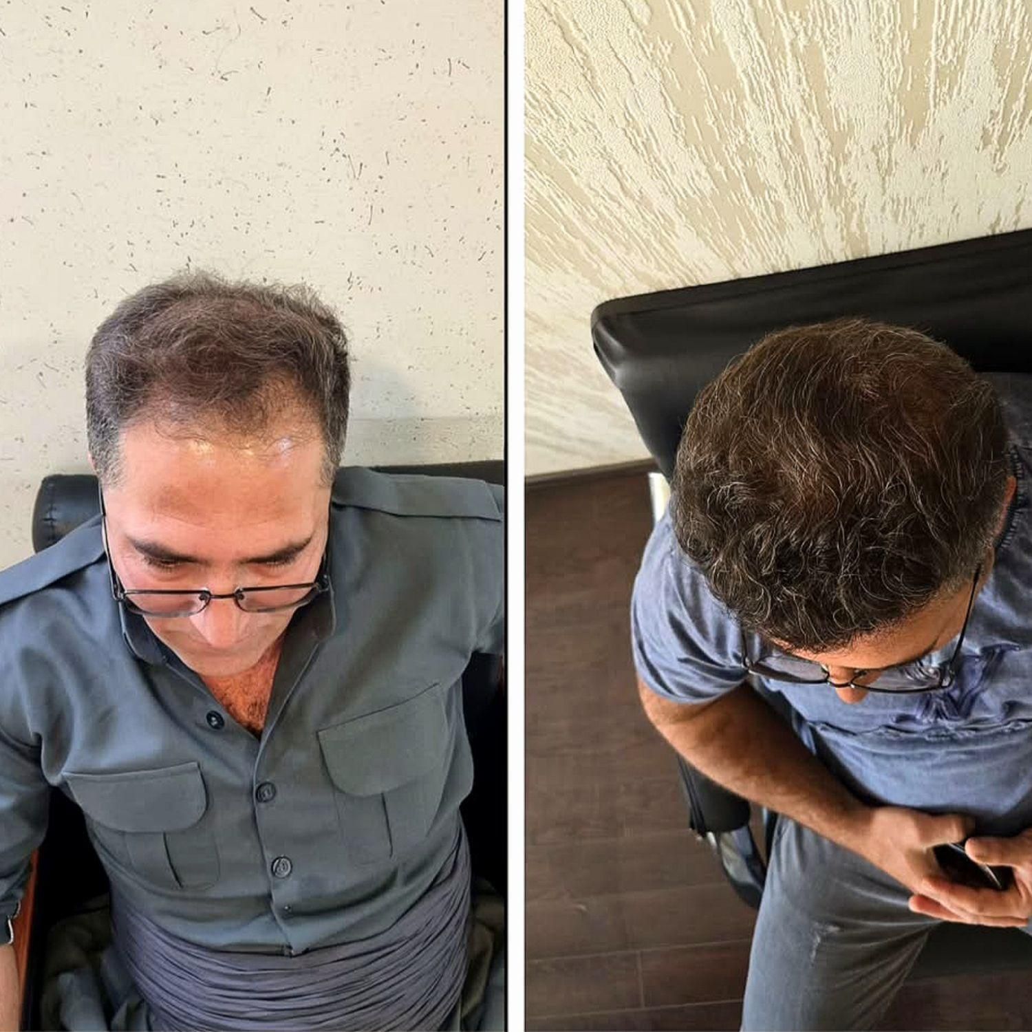 کاشت مو تضمینی و اقساطی در محیطی کاملا vip|خدمات آرایشگری و زیبایی|یزد, |دیوار