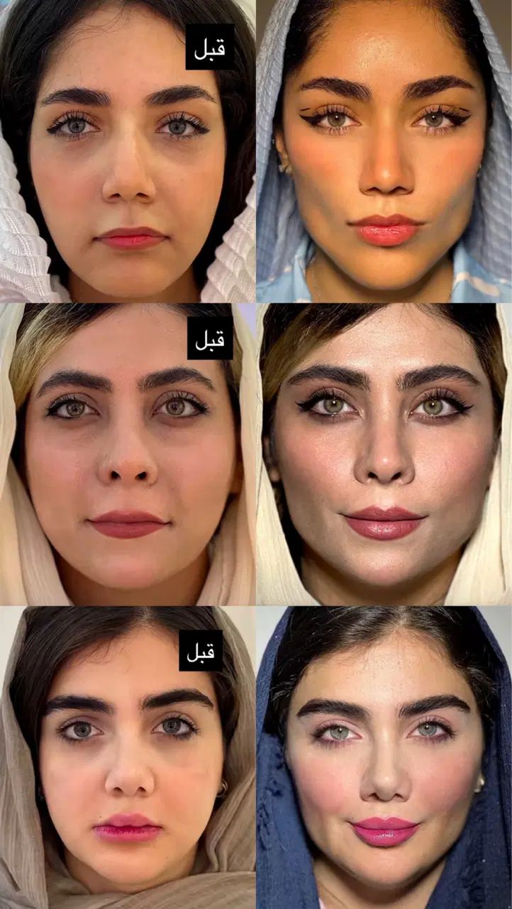 جشنواره تابستانه تزریق ژل، بوتاکس و...|خدمات آرایشگری و زیبایی|تهران, فرمانیه|دیوار