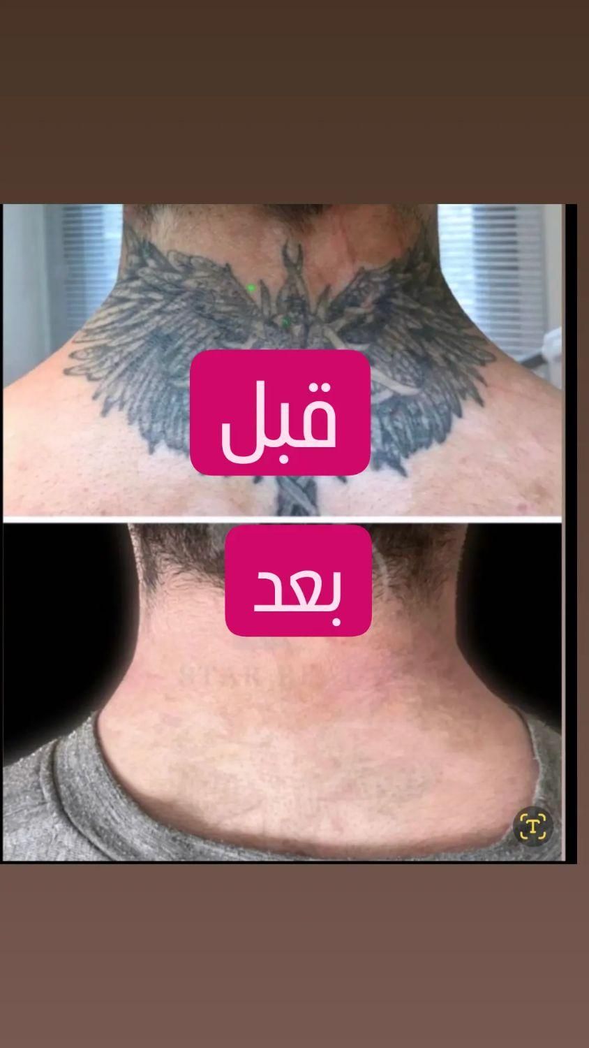 مرکز ریمو،پاک کردن،ریموو تتوابرو.بدن.خط چشم بالیزر|خدمات آرایشگری و زیبایی|شیراز, فرهنگ شهر|دیوار