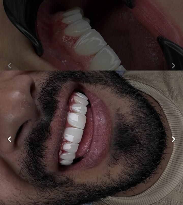 کامپوزیت‌زیبایی‌وایمپلنت‌وعصب‌کشی‌‌دندان|خدمات آرایشگری و زیبایی|تهران, شهید رجایی|دیوار