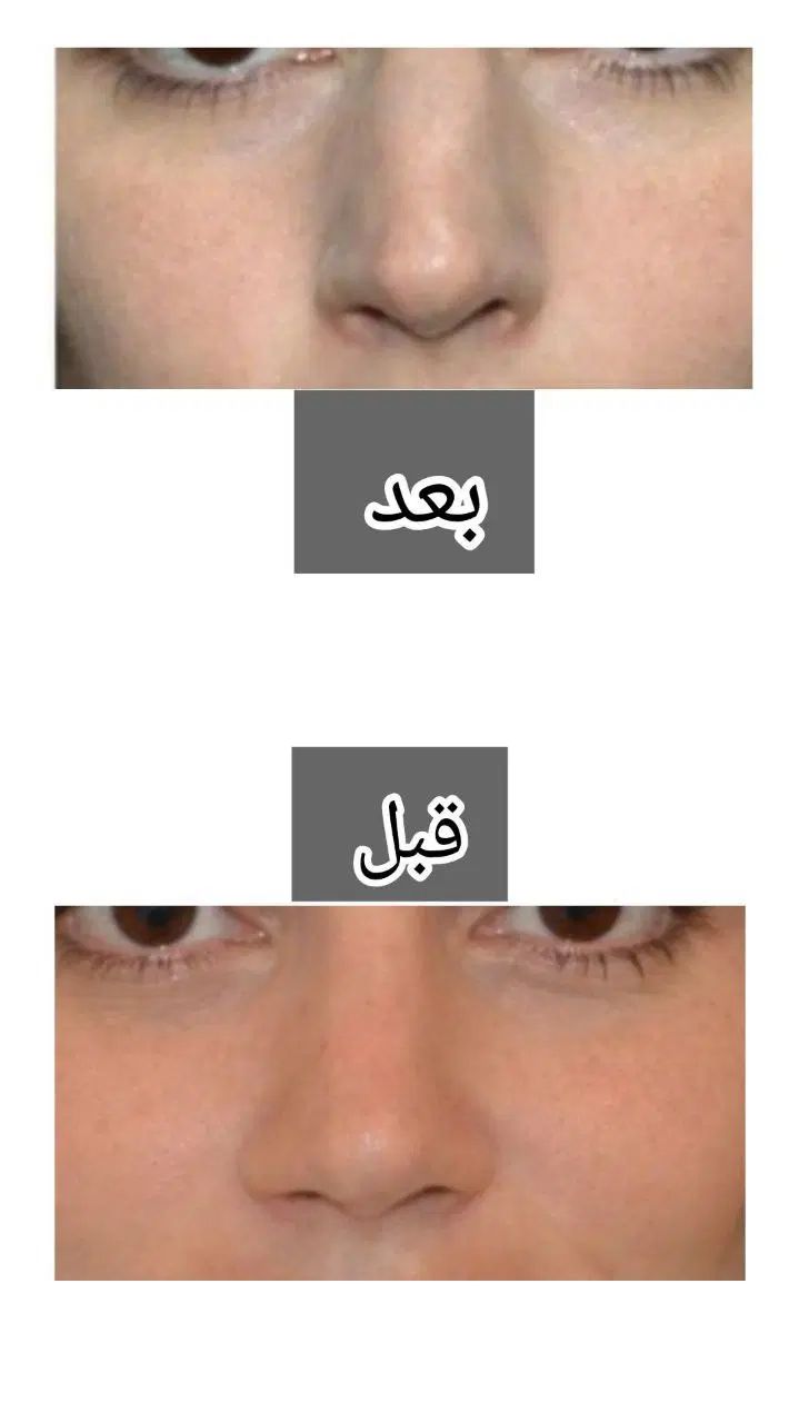 لوسیون لیفت وکوچیک کننده بینی تضمینی وبدون عوارض|آرایشی، بهداشتی، درمانی|کرمانشاه, |دیوار