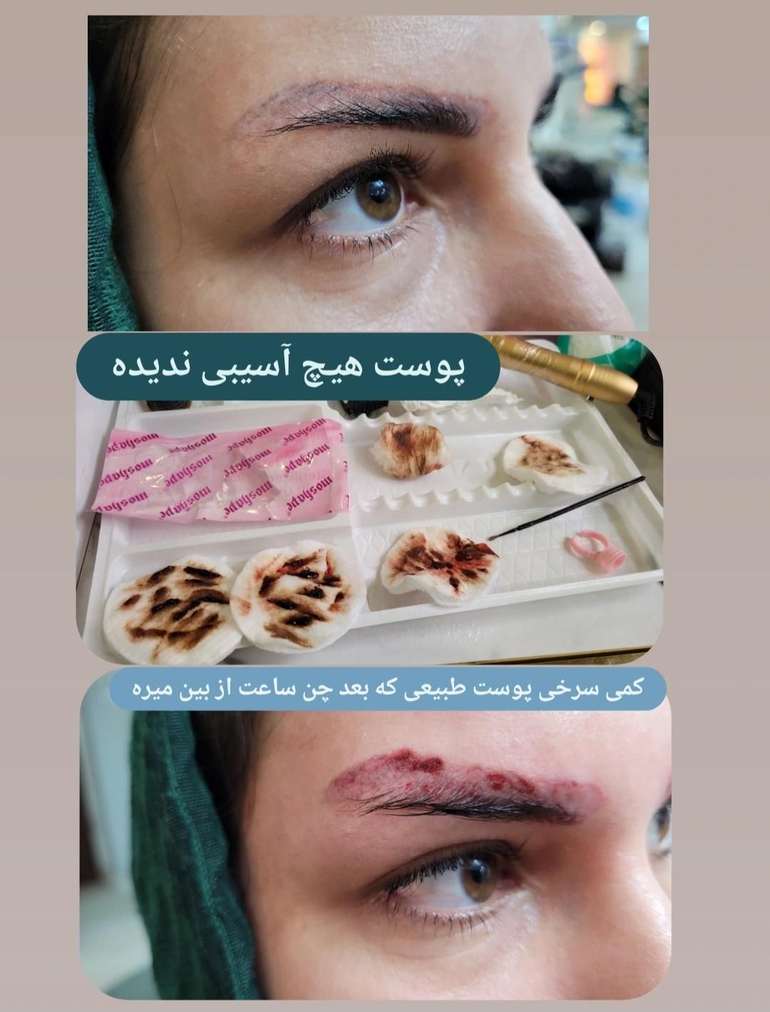ریمووپاک کردن تتوتاتوابروصورت بدن|خدمات آرایشگری و زیبایی|رشت, فلسطین|دیوار