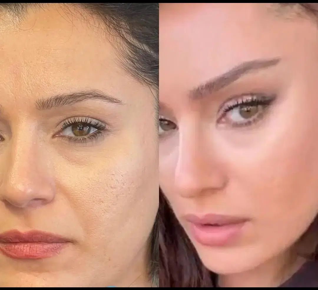 زیبایی لیفت بلفارو فرم بینی بوتاکس نخ ابروزاویه ژل|خدمات آرایشگری و زیبایی|اصفهان, بهارستان|دیوار