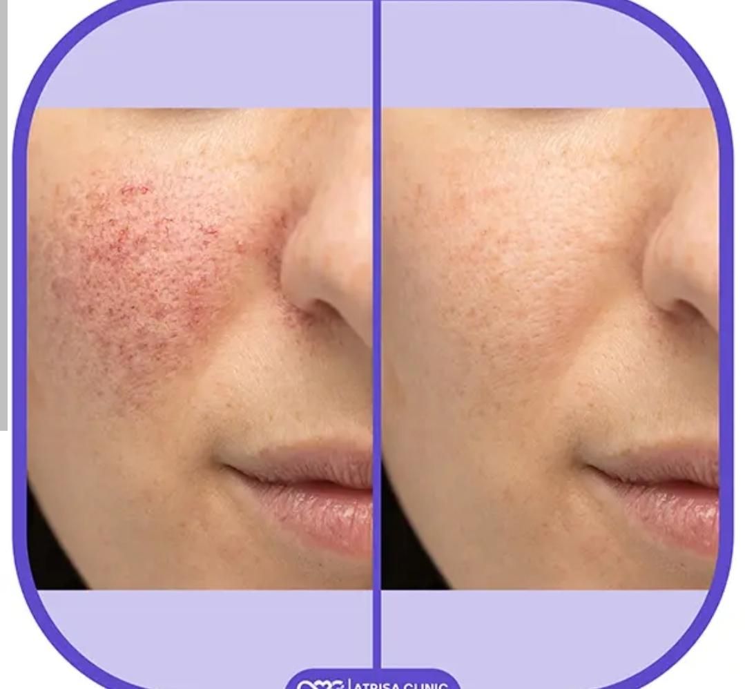 لیزر جای جوش و زخم.منافذ پوست|خدمات آرایشگری و زیبایی|نجف‌آباد, شریعتی غربی|دیوار