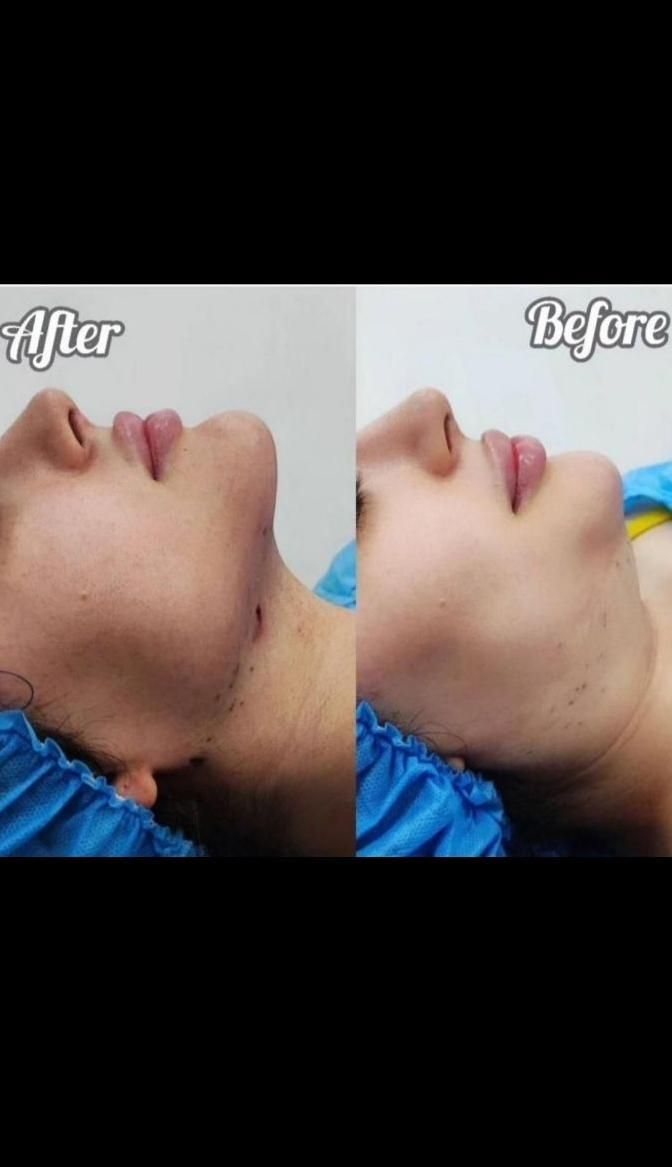 ساکشن شکم پهلو غبغب تزریق چربی ژل بوتاکس|خدمات آرایشگری و زیبایی|کرمانشاه, |دیوار