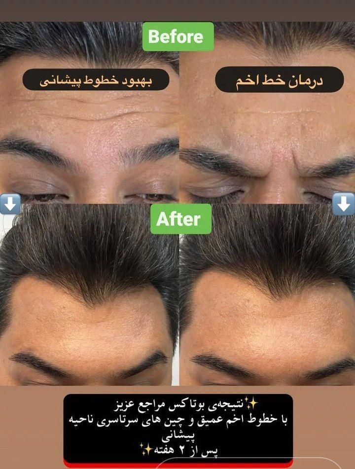 بوتاکس ژل آنزیم نخ لاغری بوتاکس 500وژل اودری350|خدمات آرایشگری و زیبایی|قم, هفت تیر|دیوار