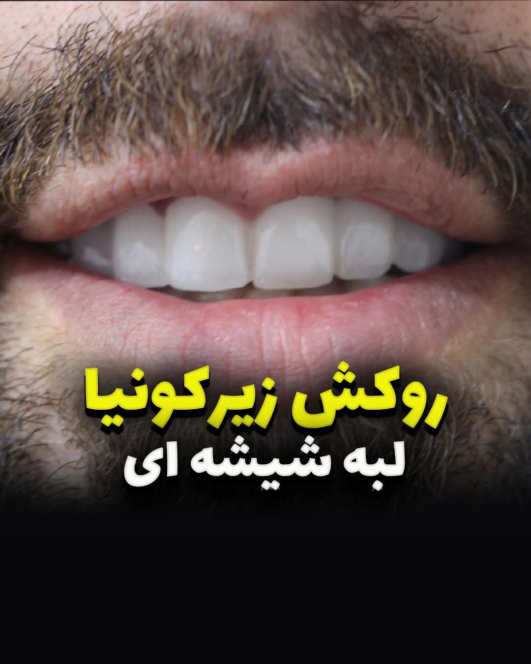 روکش زیرکونیا/ایمپلنت کره ای/ونیر|خدمات آرایشگری و زیبایی|بابل, |دیوار