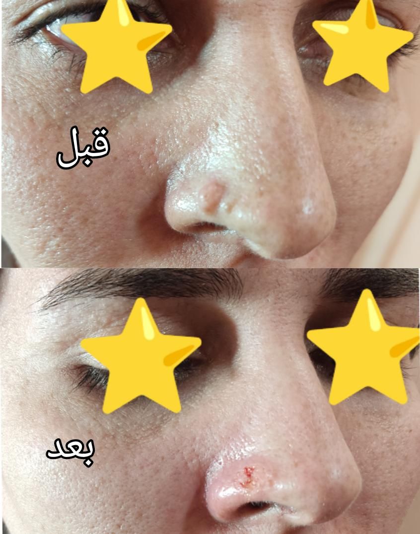 لیزر موهای زائدسوپرانو تیتانیوم وخالبرداری|خدمات آرایشگری و زیبایی|صدرا-فارس, فاز ۱|دیوار