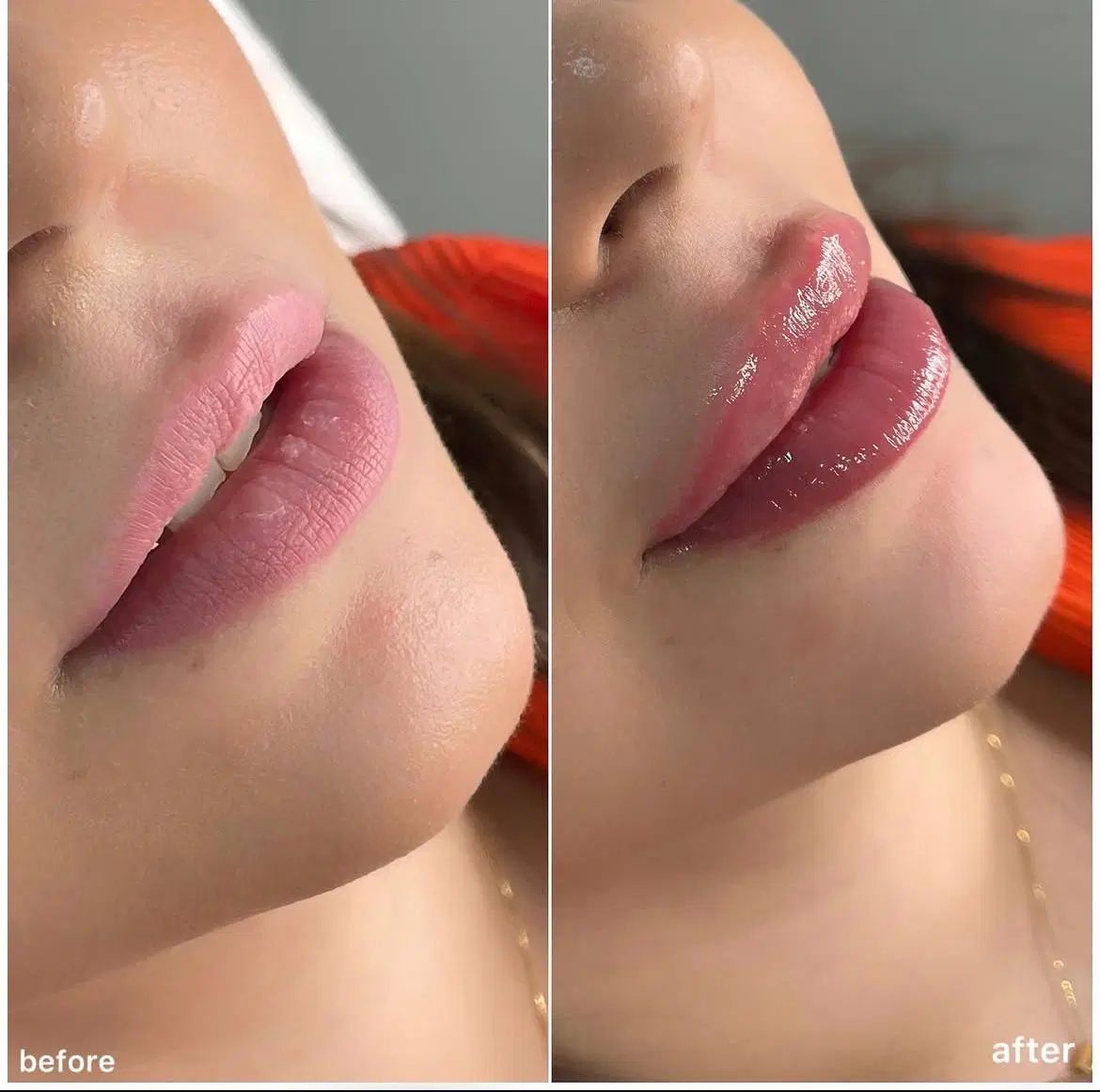 تزریق فیلر بادی کانتورینگ صورت بوتاکس ژل لب|خدمات آرایشگری و زیبایی|تهران, جردن|دیوار