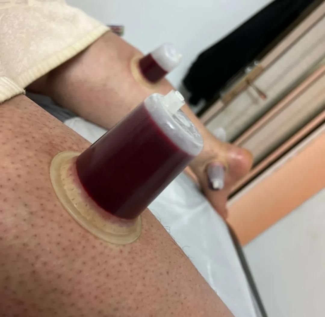 زالودرمانی / حجامت/ بادکش درمانگرآقاوخانم باسابقه|خدمات آرایشگری و زیبایی|مشهد, امام رضا (ع)|دیوار