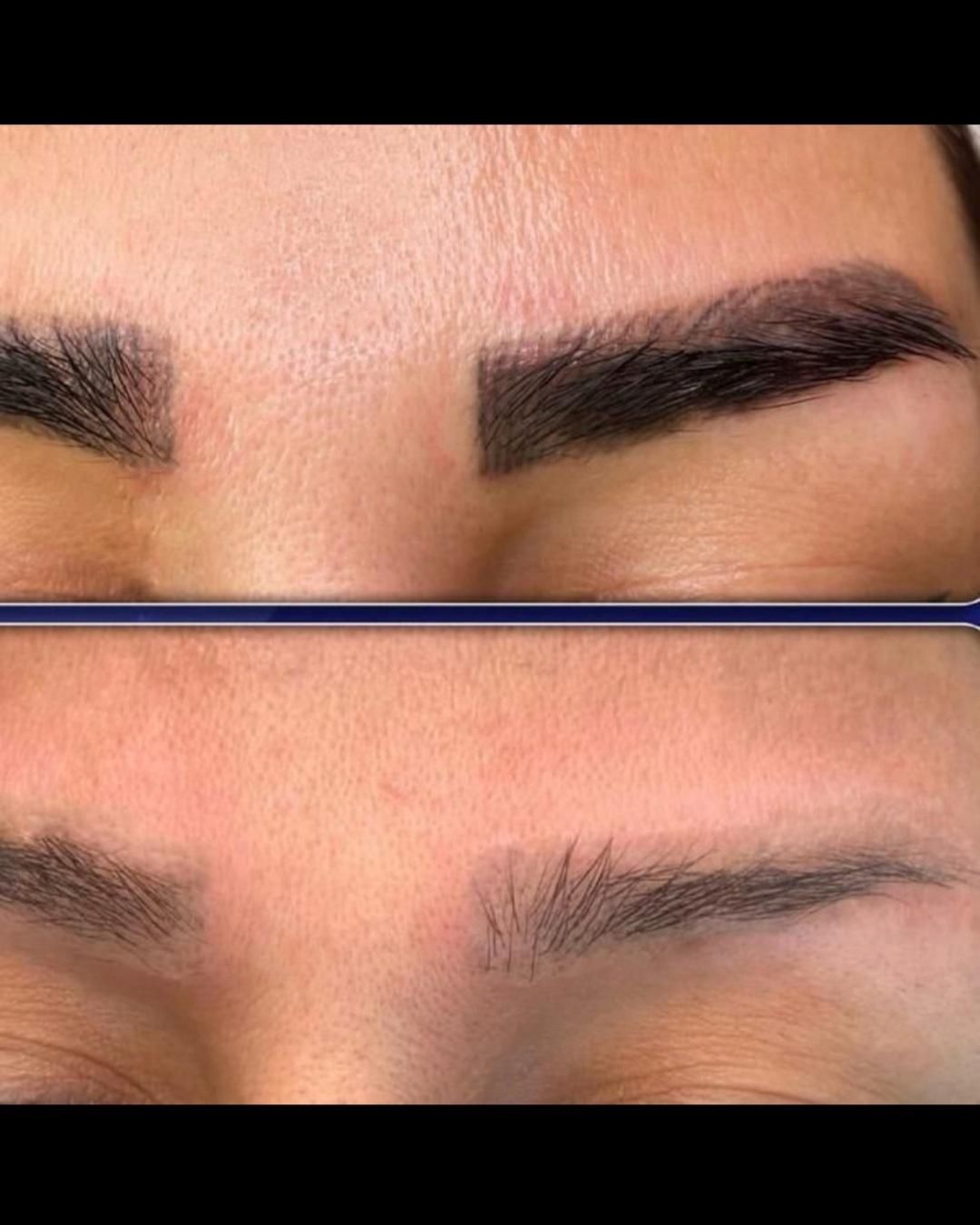 ریموو تتو صورت و بدن|خدمات آرایشگری و زیبایی|کرمانشاه, |دیوار