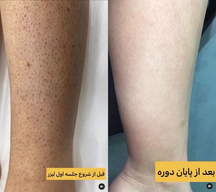 لیزر موهای زائدخانمها و آقایان ۳۹۰|خدمات آرایشگری و زیبایی|تهران, صادقیه|دیوار