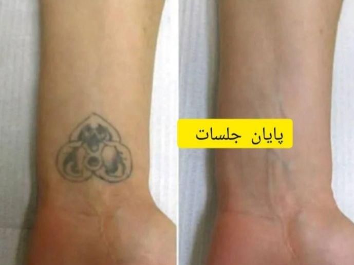 پاک کردن تتو جدیدترین دستگاهای روز دنیا|خدمات آرایشگری و زیبایی|اهواز, نادری|دیوار