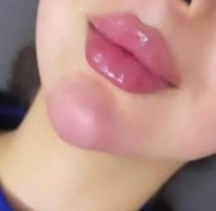 ژل بوتاکس مزو فیلر انزیم فیلر فشیال|خدمات آرایشگری و زیبایی|اسلامشهر, مطهری|دیوار