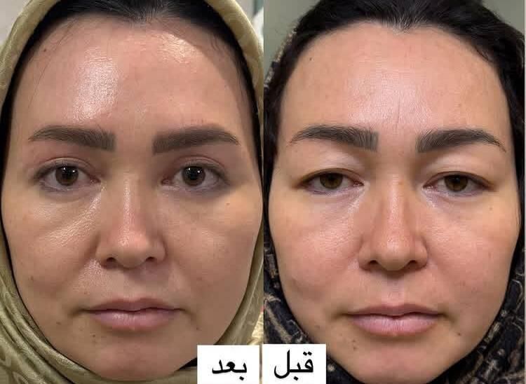 جراحی و زیبایی صورت و بدن، مزو، بوتاکس، چربی، فیلر|خدمات آرایشگری و زیبایی|کرمانشاه, |دیوار