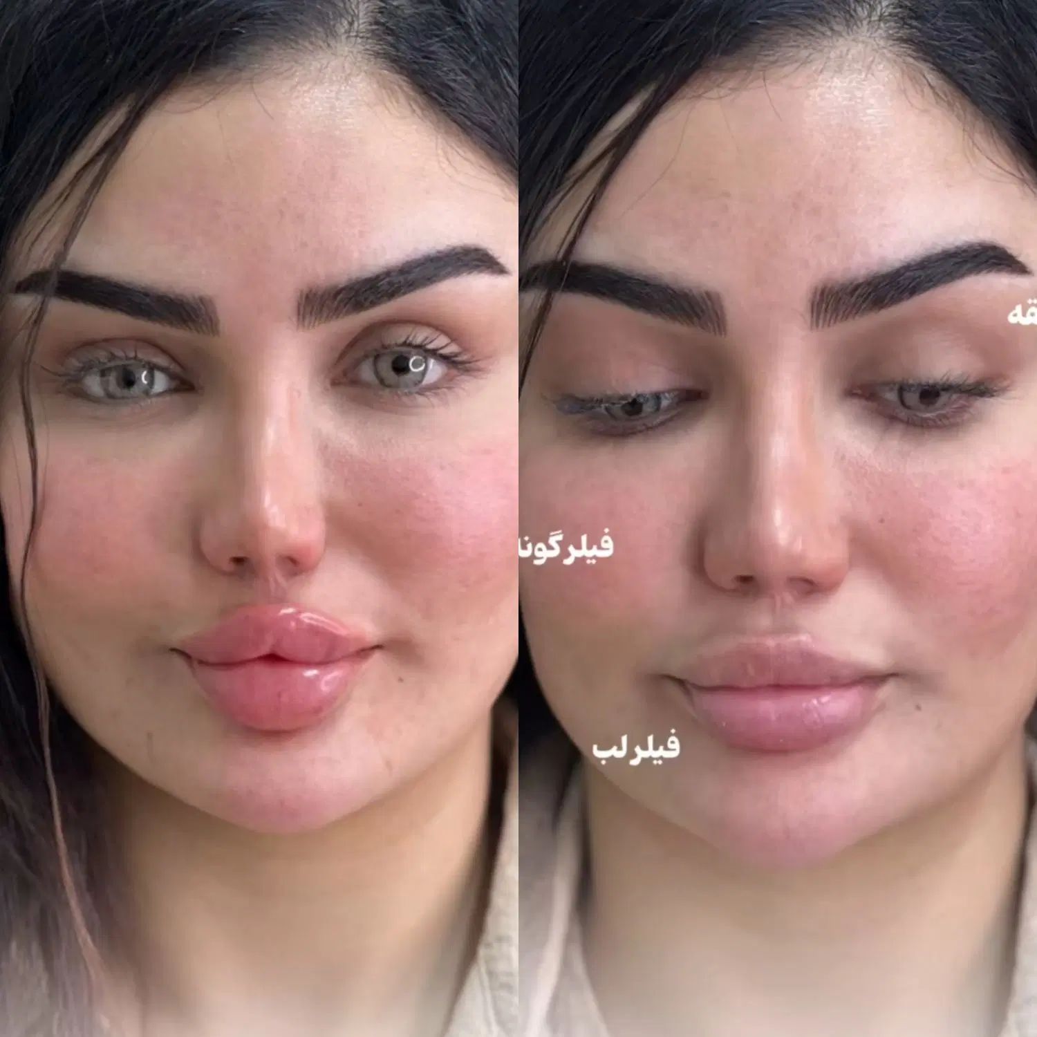 تزریق ژل بوتاکس لیفت صورت وشقیقه آنزیم مزو|خدمات آرایشگری و زیبایی|تهران, صادقیه|دیوار