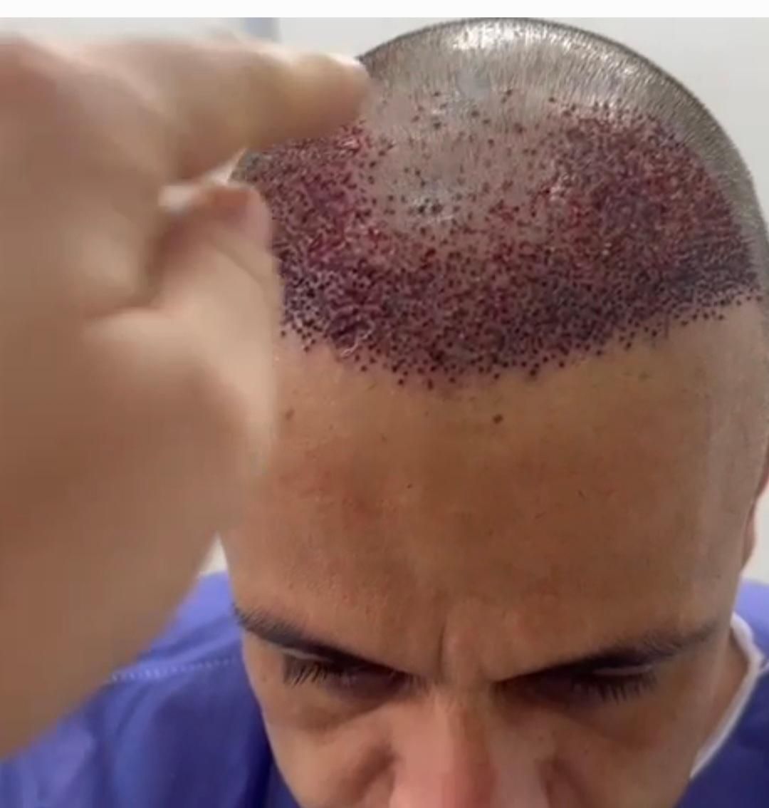 کاشت مو|خدمات آرایشگری و زیبایی|ایلام, |دیوار