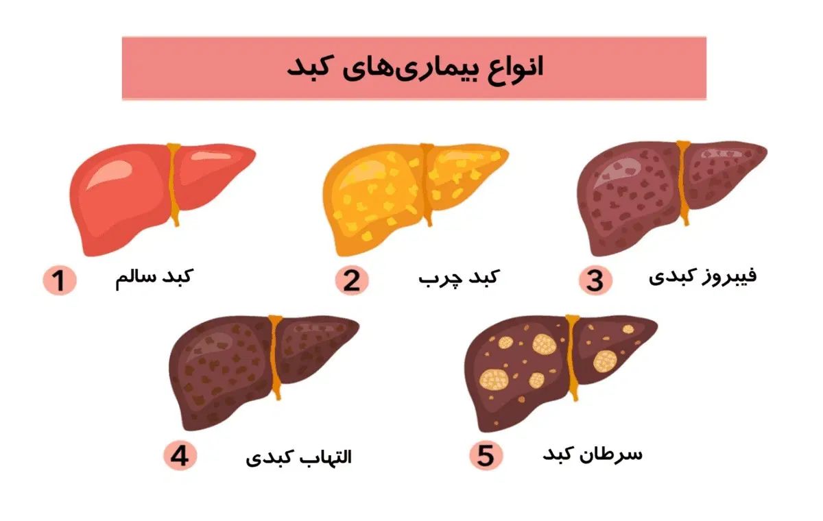 درمان کبد چرب گرید 1تا 3|آرایشی، بهداشتی، درمانی|رشت, پسیخان|دیوار
