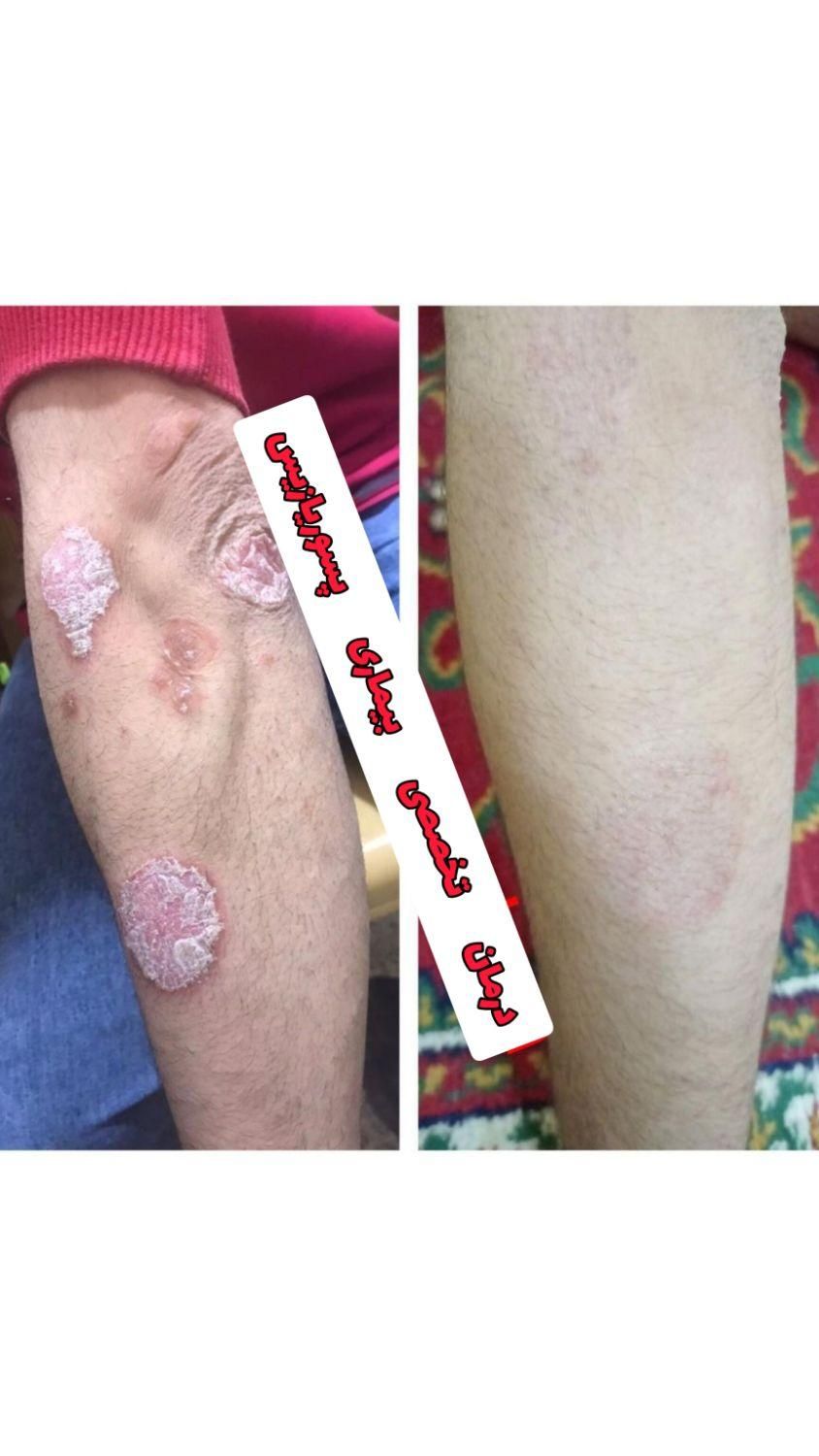 درمان گیاهی بیماری پیسی وپسوریازیس|خدمات آرایشگری و زیبایی|مشهد, حرم مطهر رضوی|دیوار