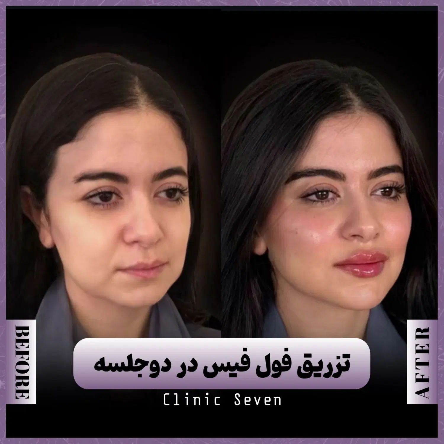 تخفیفات ۵۵٪ دکتر ملائی ،مزو بوتاکس فیلر ژل لب روسی|خدمات آرایشگری و زیبایی|مشهد, کوثر|دیوار