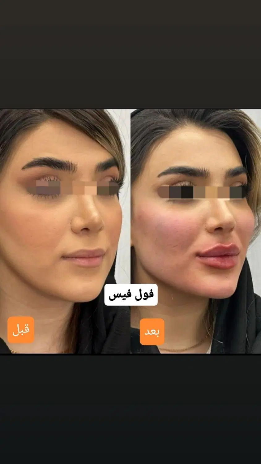 جشنواره/فیلر/بوتاکس/آنزیم/تخفیف دکترفیروزی|خدمات آرایشگری و زیبایی|شیراز, زرهی|دیوار