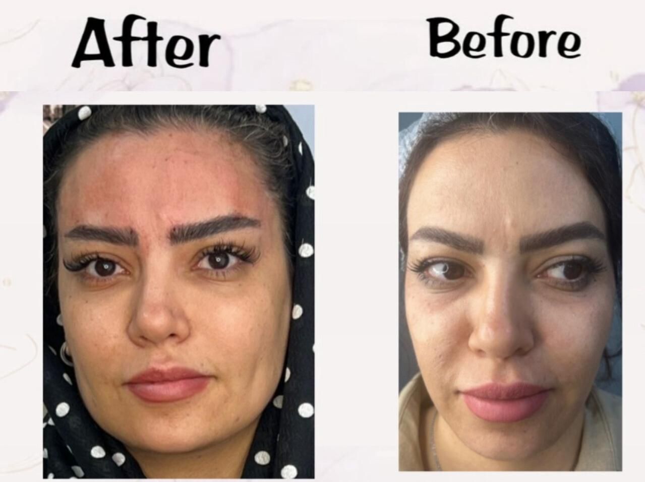 تزریق فیلر بوتاکس و لیفت افتادگی صورت و چشم|خدمات آرایشگری و زیبایی|شیراز, عفیف‌آباد|دیوار