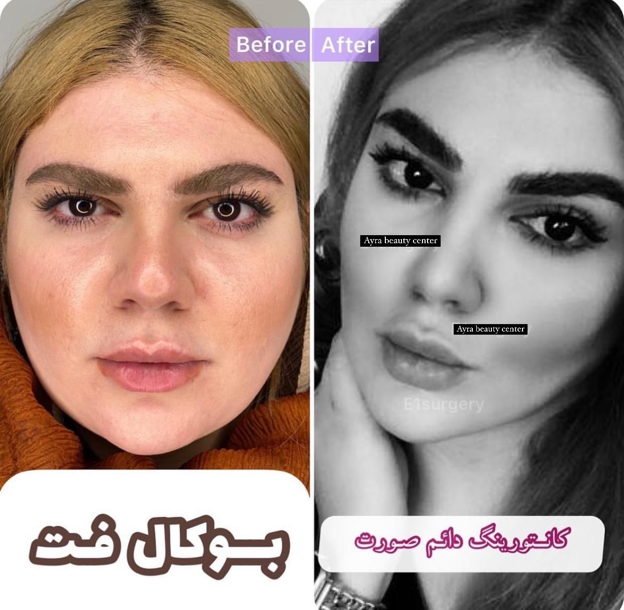 جشنوار بلفاروپلاستی-غبغب-بوکال فت-سانترال لب|خدمات آرایشگری و زیبایی|تهران, پاسداران|دیوار