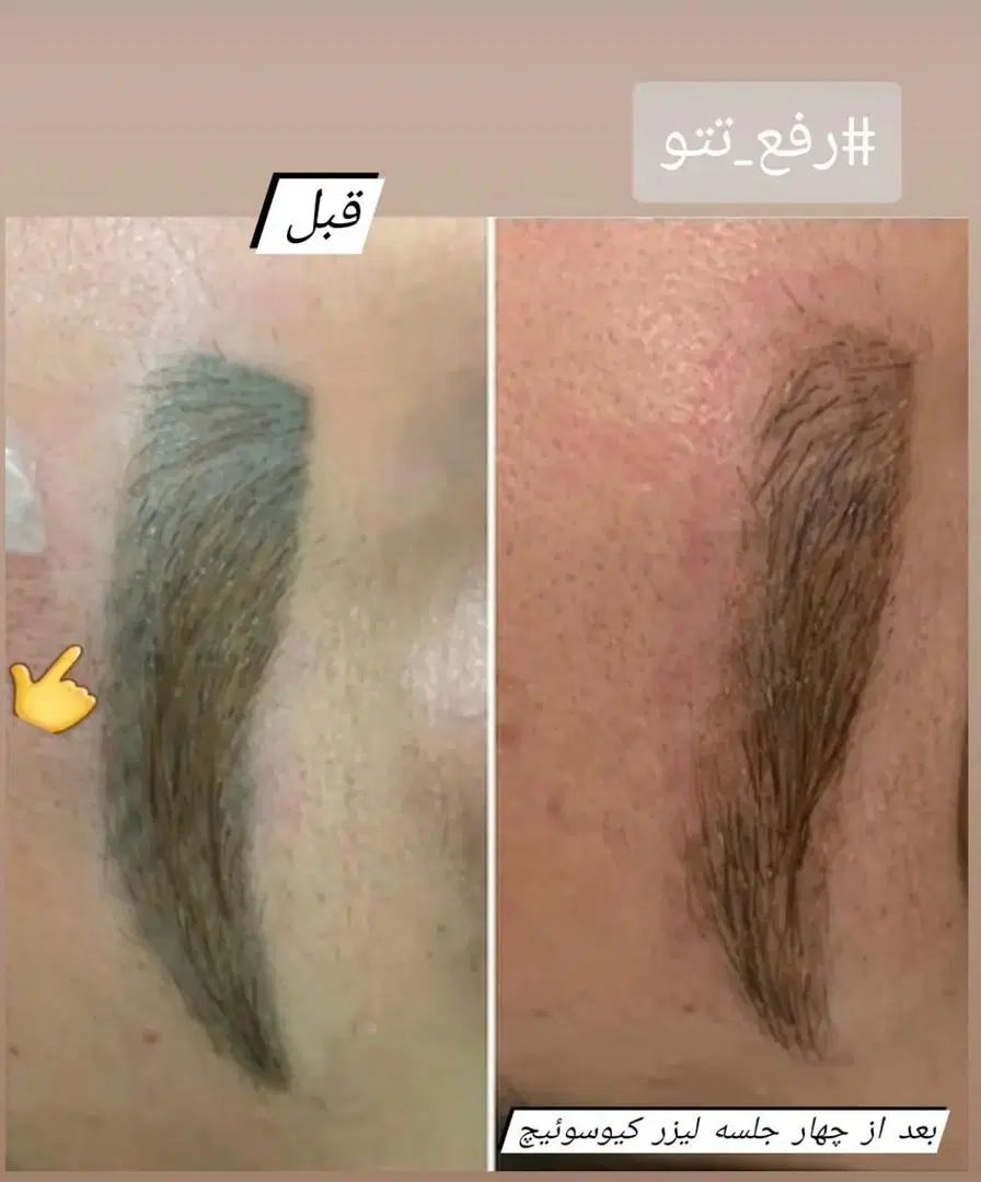 پاک کردن انواع تتو و روشن کردن نواحی تیره|خدمات آرایشگری و زیبایی|رشت, منظریه|دیوار
