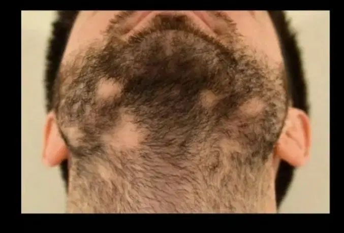 دیگه با ریزش موهات خداحافظی کن|آرایشی، بهداشتی، درمانی|کرج, عظیمیه|دیوار
