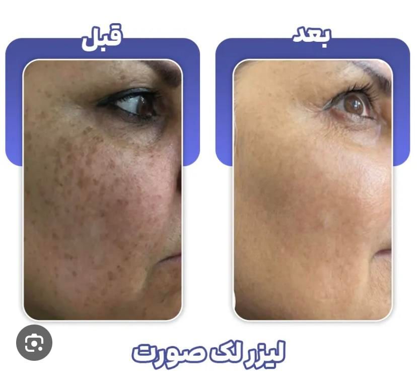 حذف انواع ککومک لک ملاسما و تیرگی در یک جلسه|خدمات آرایشگری و زیبایی|همدان, |دیوار