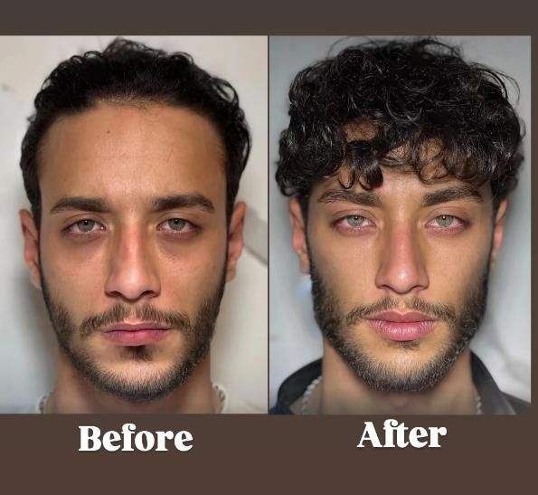 تزریق فیلر ژل/بوتاکس/prp پوست مو/پی آر‌پی/مزوتراپی|خدمات آرایشگری و زیبایی|کرج, گوهردشت|دیوار