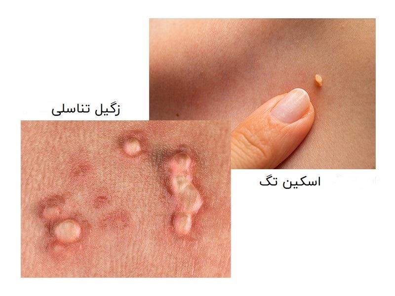 زگیل تناسلی.لیزر زگیل.کرایوتراپی فریز.درمان پوست|خدمات آرایشگری و زیبایی|اهواز, کیانپارس |دیوار