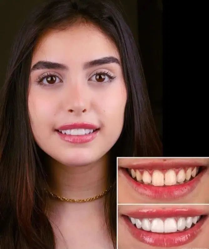 کامپوزیت.لمینت.پروتز.دست دندان|خدمات آرایشگری و زیبایی|تهران, مجیدیه|دیوار