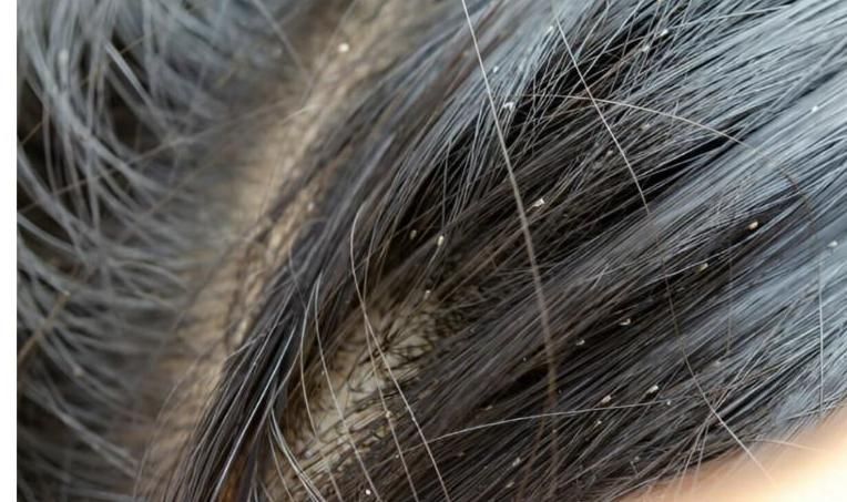 درمان صدرصدقطعی وتضمینی شپش ورشک برای همیشه|آرایشی، بهداشتی، درمانی|نورآباد, |دیوار