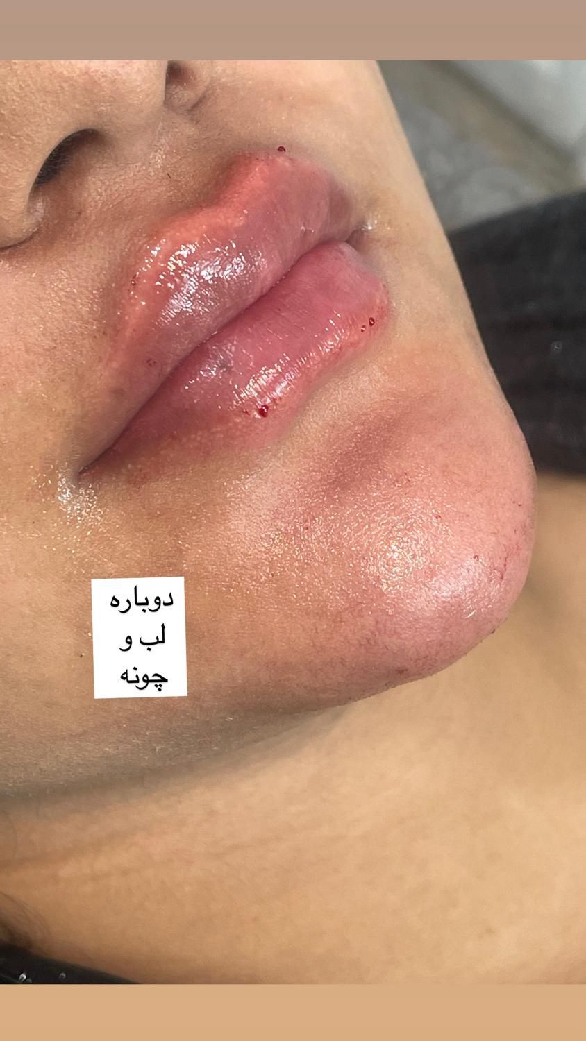 ژل و بوتاکس ‌‌پاکسازی|خدمات آرایشگری و زیبایی|مشهد, شهید معقول|دیوار