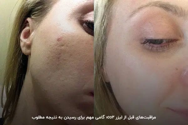 جوانسازی پوست و نواحی بانوان با لیزر تخصصی فوتونا|خدمات آرایشگری و زیبایی|محمدیه-قزوین, |دیوار